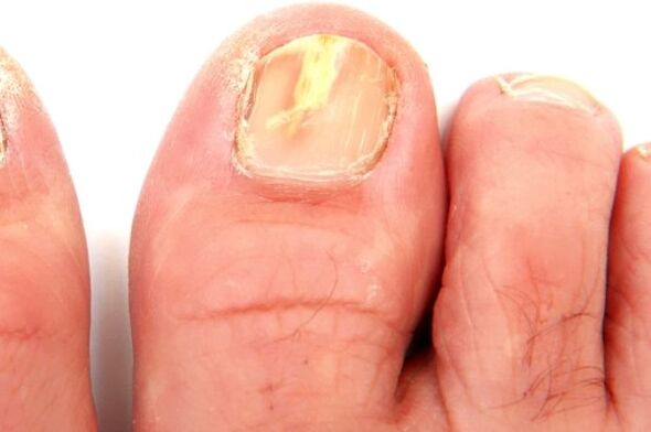 a körömlemez gombás fertőzés miatti károsodása