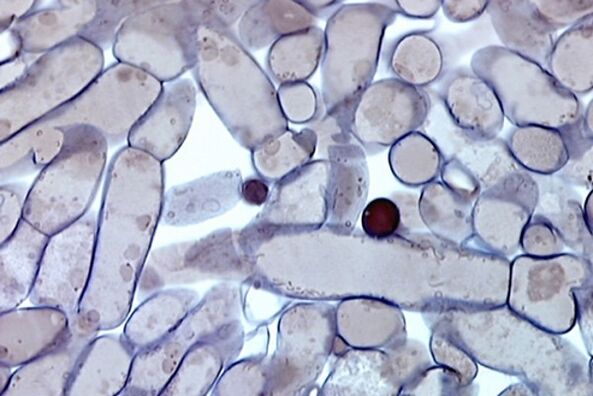 körömgomba sejtek mikroszkóp alatt